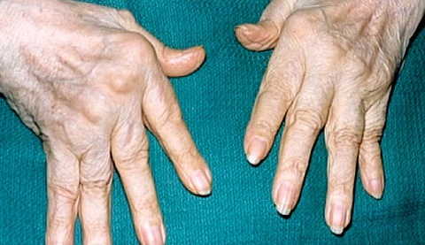 Причины ревматоидного артрита у взрослых